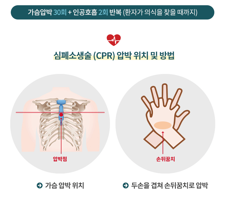 CPR방법