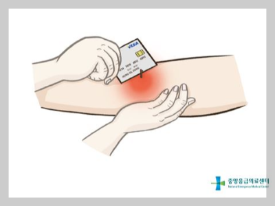 벌에-쏘였을-때-응급처치방법-벌침-제거