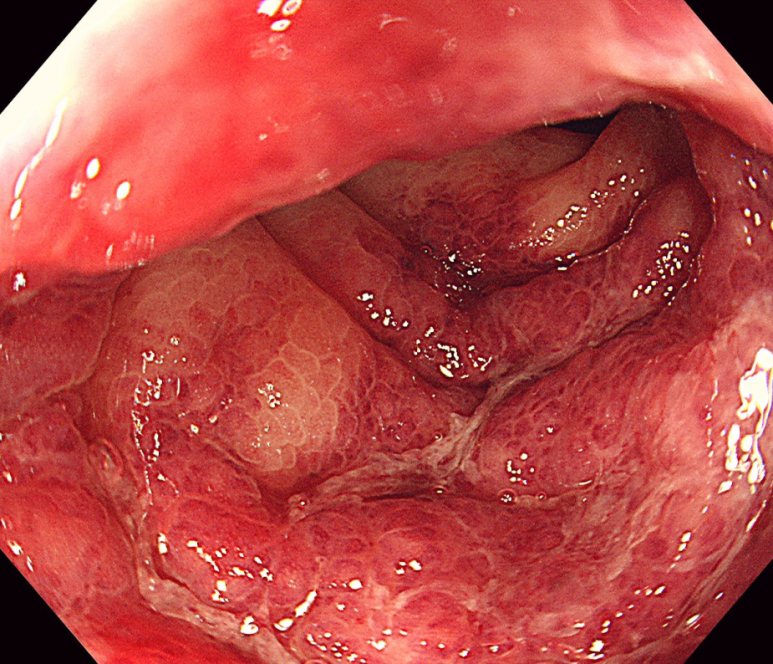 허혈성 대장염 사진