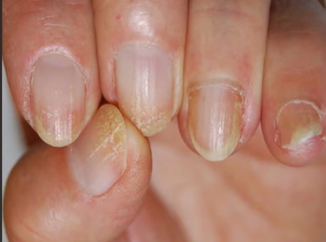 손톱이 잘 부러지는 이유