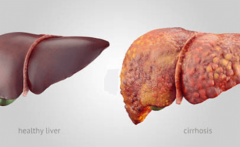 간경화 초기증상, 꼭 알아야 할 정보 총정리