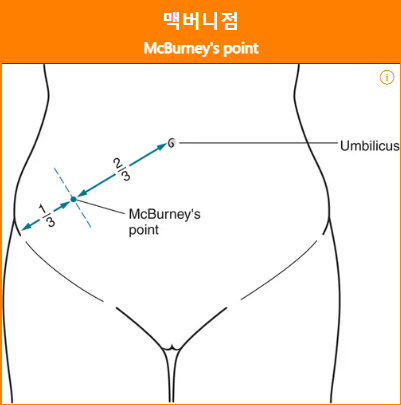맹장염 압통 부위-맥버니점