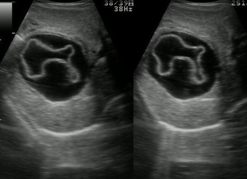 daughter cyst and water-lily sign