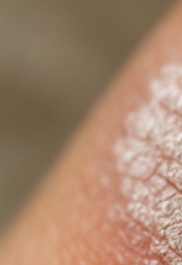 건선 피부염 완전정리