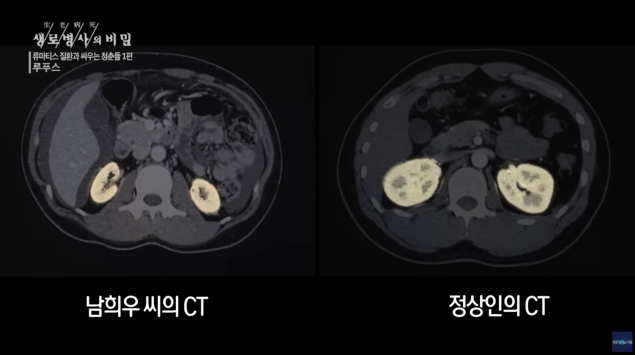 루프스 천의얼굴 동행의병 제2의삶 관리의시대