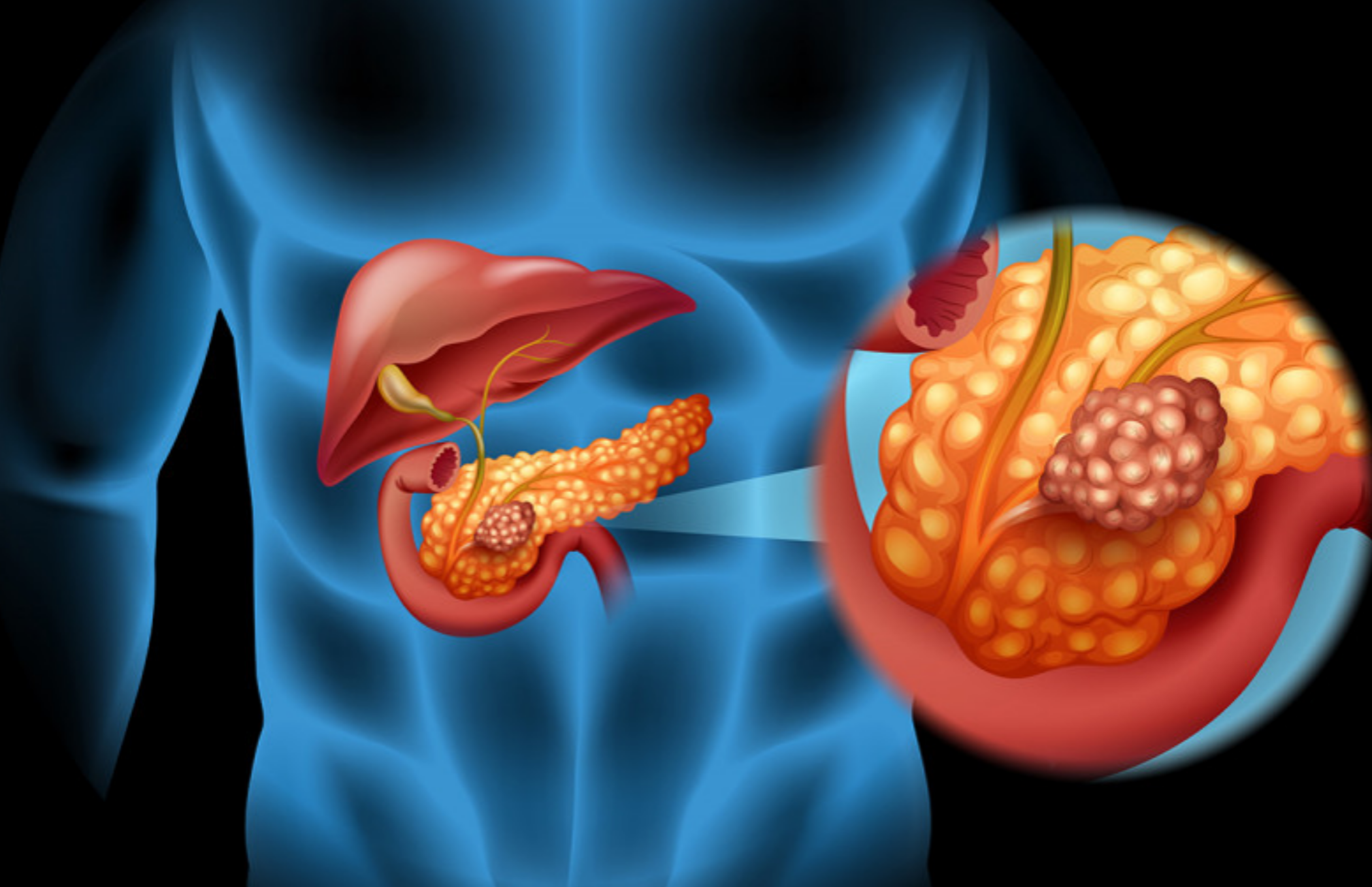 췌장암 원인 증상 힐링치유사례
