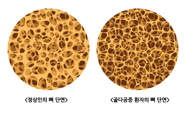 골다공증