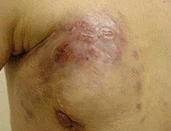 유방암 초기증상