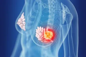 유방암-2기-생존율