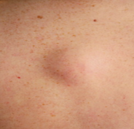 지방종의 확인 및 진단