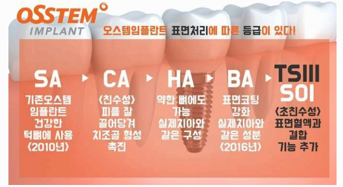 오스템 임플란트 종류별 차이 사진