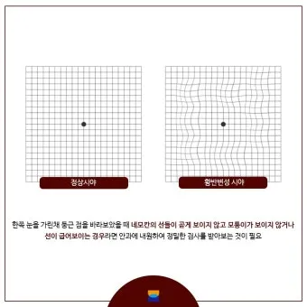 시야에 검은점 시야에 까만점이 보일때 원인과 대처법_5