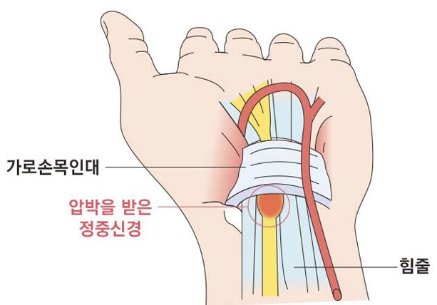 손목터널증후군