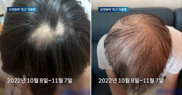 경기도 한 요양원에서 사회복무요원으로 근무하던 김모(23)씨는 지난해 10월 갑작스러운 탈모가 시작돼 불과 한 달 만에 머리카락이 거의 없을 정도로 빠져 공무상 질병을 인정해 달라고 호소했지만 복무기관은 이를 받아들이지 않았다. 사진은 한 달 사이 머리카락이 급격히 빠져가는 과정(왼쪽&rarr;오른쪽). [사진=JTBC 보도화면 캡처]