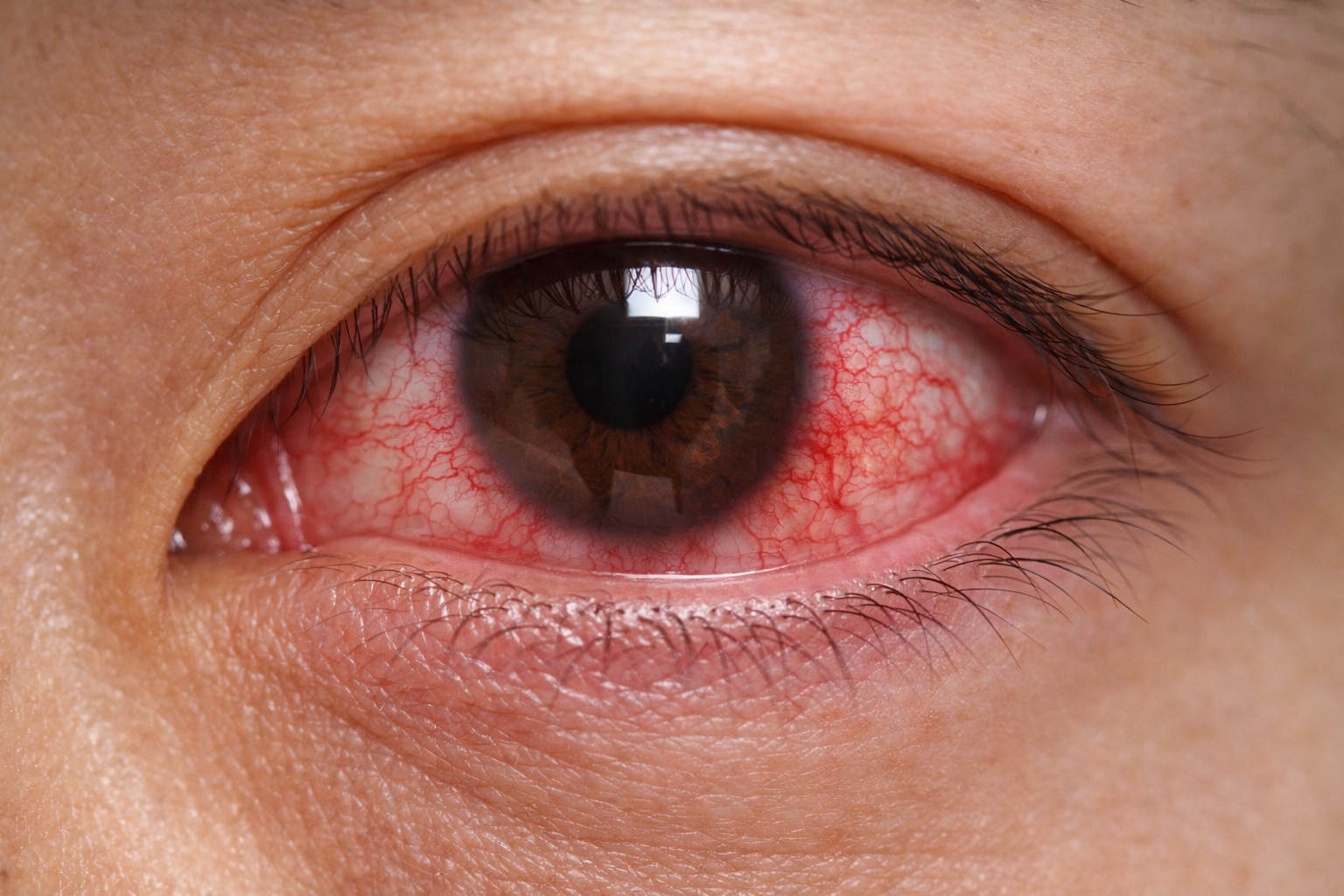 결막염 원인&middot;증상&middot;치료