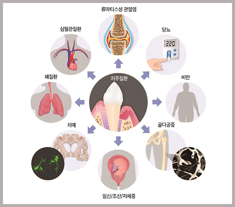 당뇨와 치주질환의 악순환 구조-치주질환으로인한질환