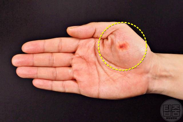 피부암 호발 부위 피부암자가진단 손바닥