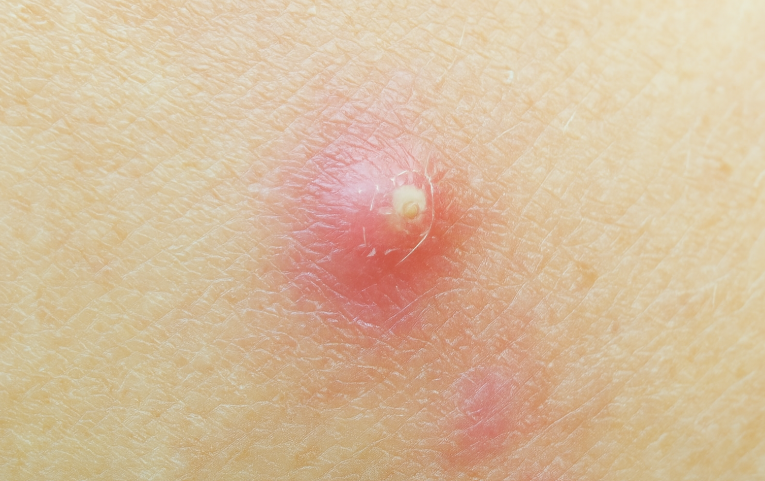 겨드랑이 엉덩이 종기, 화농성 한선염