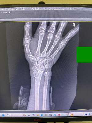 병원 모니터에서 확인하는 소아 성장판 검사 왼쪽 손목 X-ray 엑스레이 영상