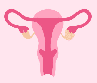 자궁근종 증상 7가지, 수술후 회복기간