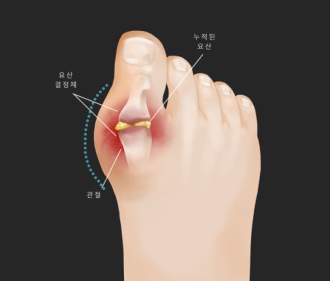 발가락 통풍 증상