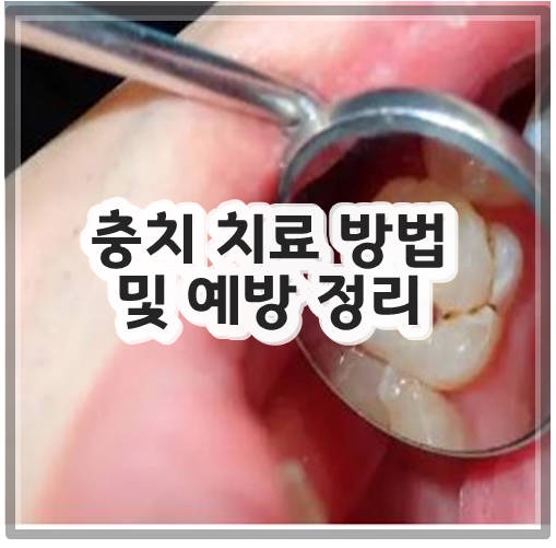 충치 치료 방법 및 예방 정리