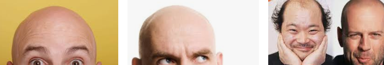 대머리 머리 사진
