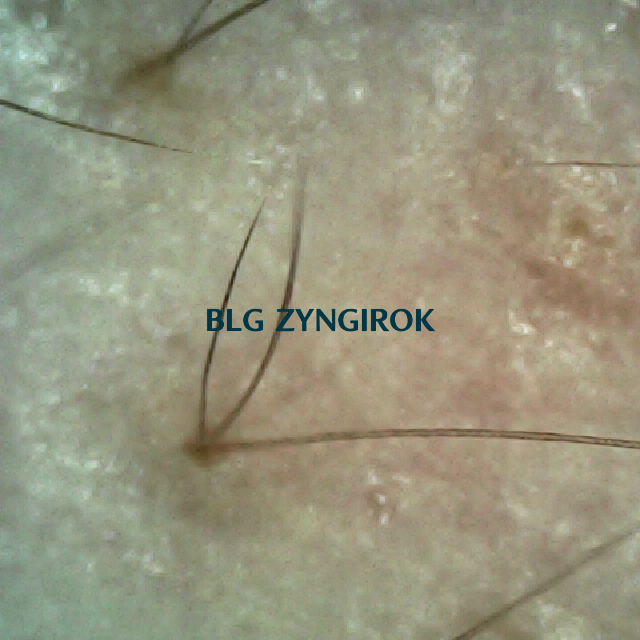 오른쪽 M자 부위 두피 모습이다.