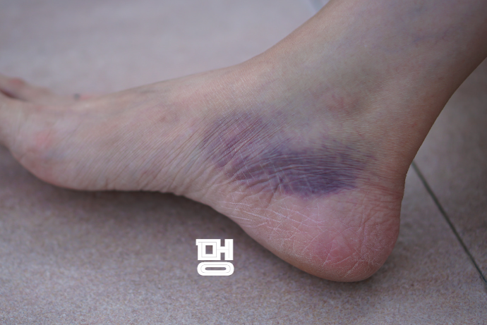 비타민 K 결핍 증상, 멍이 쉽게 듦