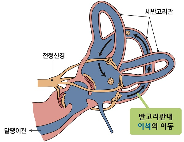 이석증 증상과 자가치료법