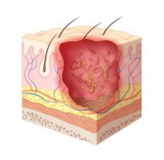 단계 - 전층 피부 손실