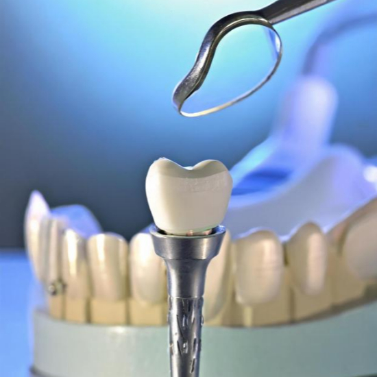 임플란트 시술과정 단계별 설명5