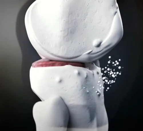 무릎 퇴행성관절염이 생기는 모습