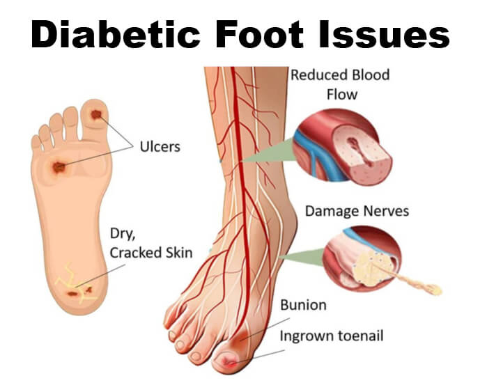 당뇨발-초기-증상-사진