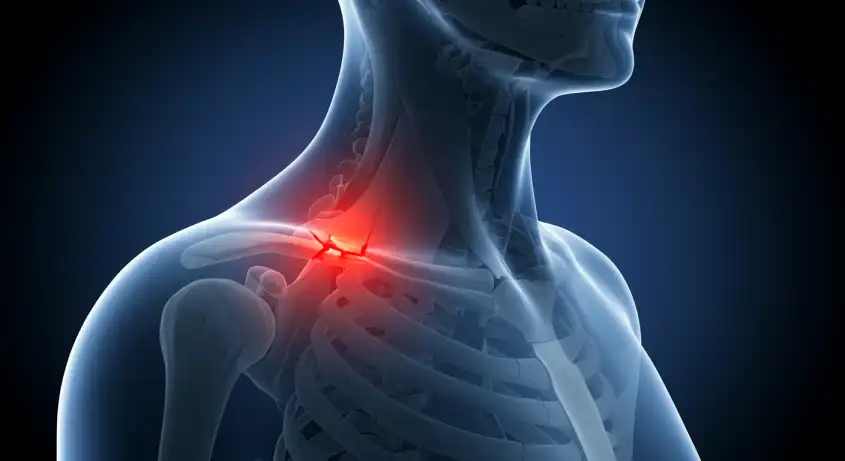 쇄골 골절 후유증과 원인, 예방 관리법