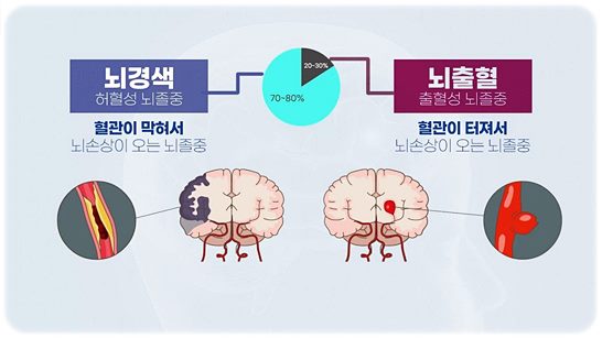 뇌출혈 치료 핵심
