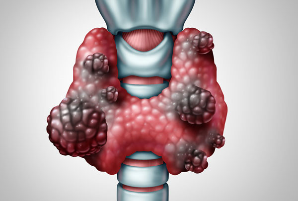 갑상선 유두암이란