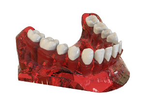 임플란트 가격에 영향을 미치는 요소