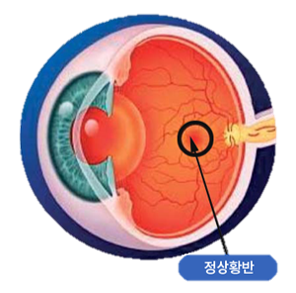 정상황반