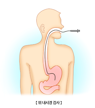 역류성 식도염 원인과 예방