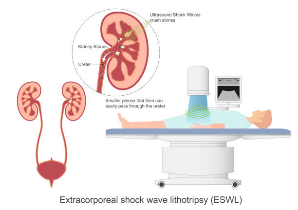 체외 충격파 쇄석술