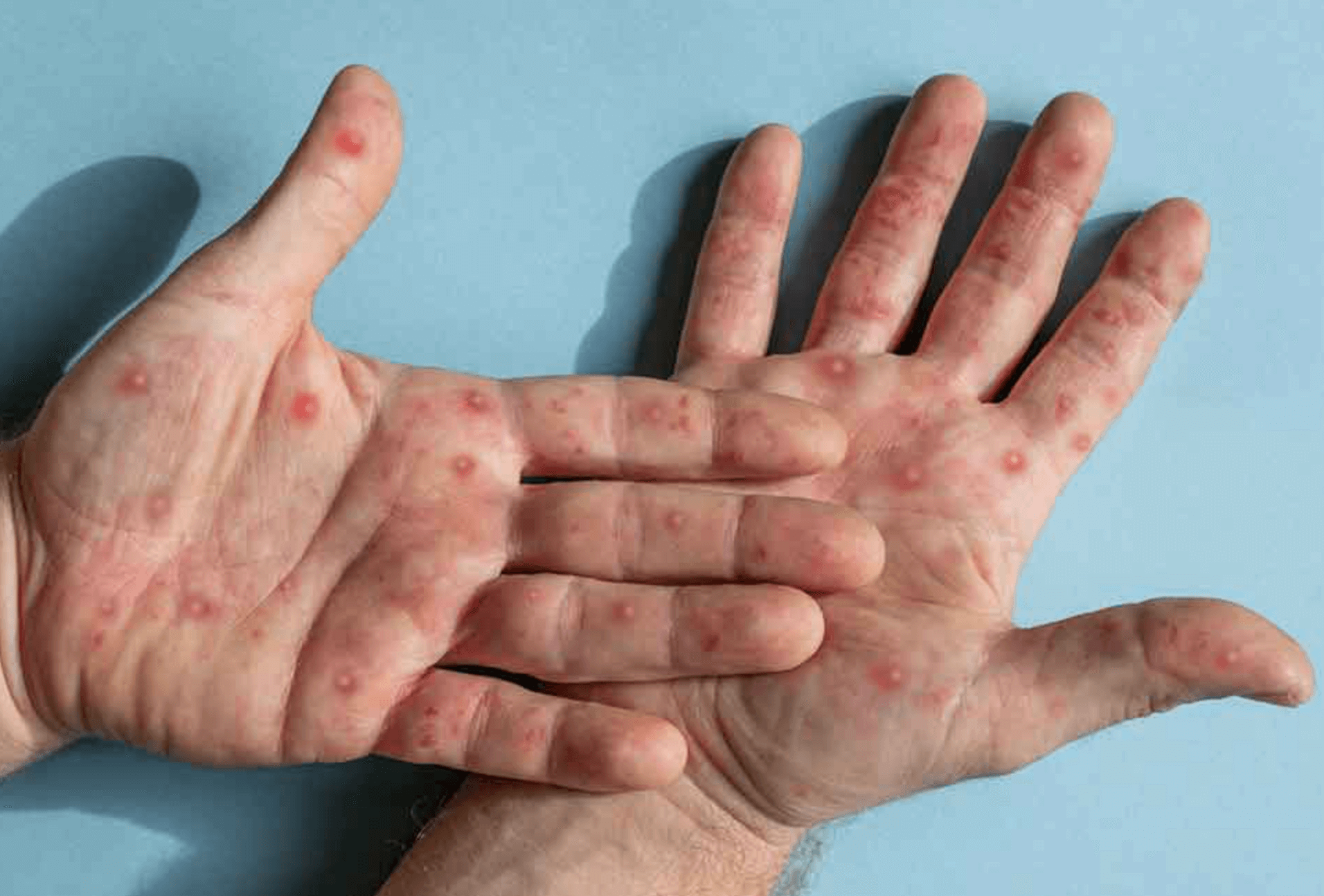 원숭이두창 전염성