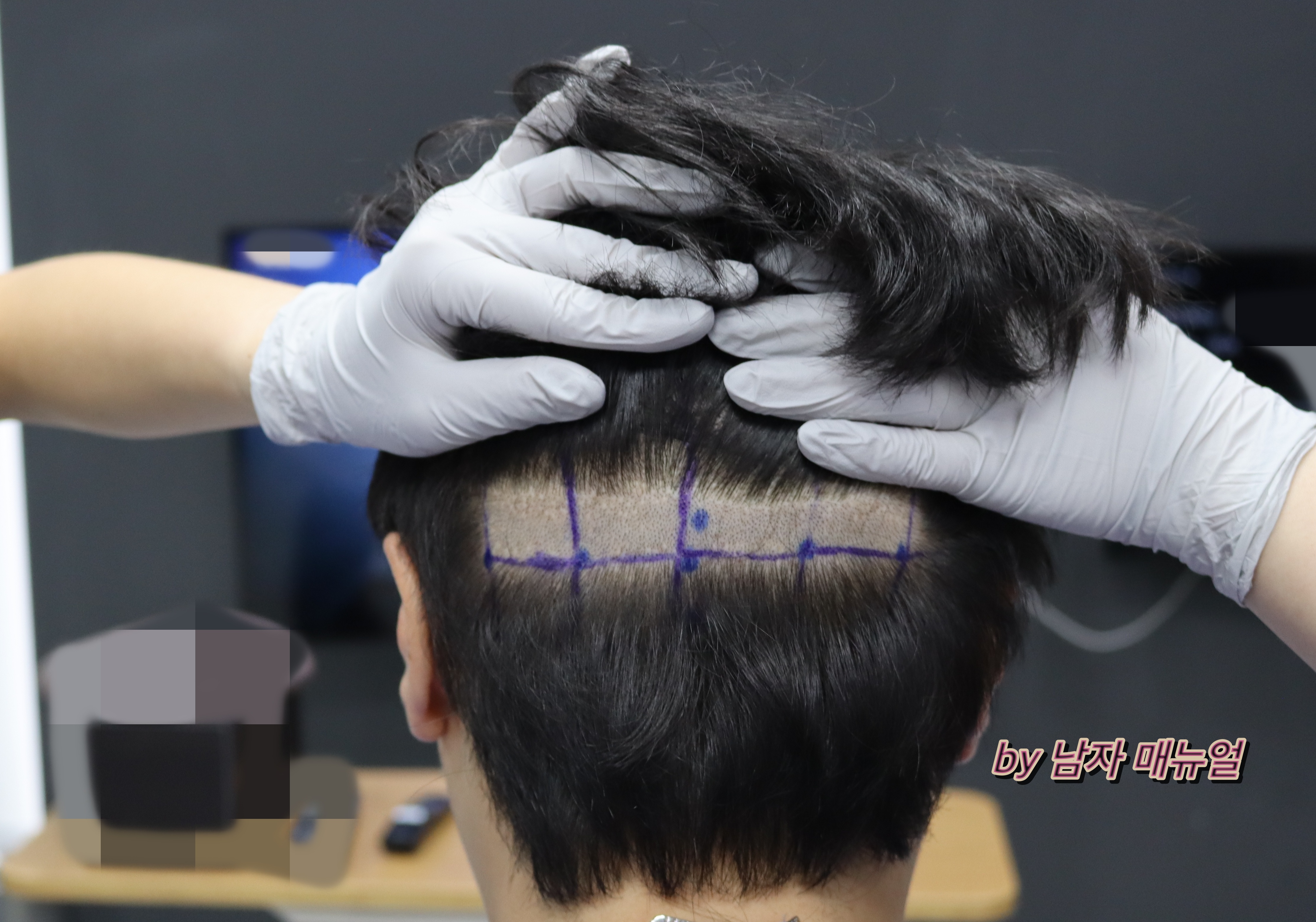 남자-모발이식-후기