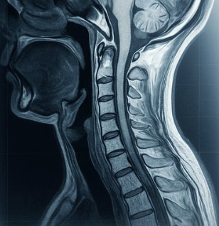 목디스크와 경추척수증&amp;#44; 완전히 다른 두 질환의 결정적 차이점