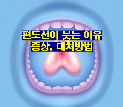 편도선이 붓는이유, 편도선염, 편도선염 증상, 편도선염에 좋은 음식, 편도선 증상