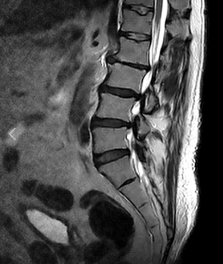 요추 염좌 원인