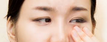 눈꺼풀 떨림 현상