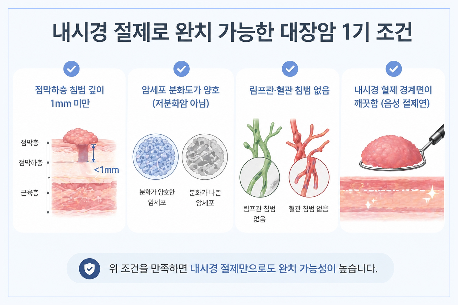 대장암 1기 내시경 절제 조건