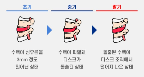 허리디스크(요추 추간판 탈출증) 관련 이미지