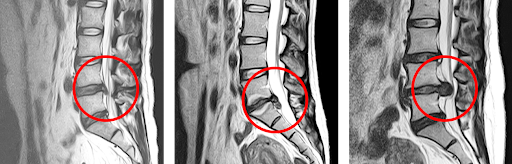 허리디스크 수술 전 MRI 판독을 진행하고 있다.